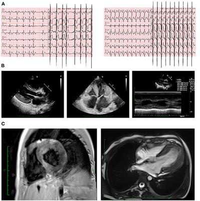 Genetic Clues on Implantable Cardioverter-Defibrillator Placement in Young-Age Hypertrophic Cardiomyopathy: A Case Report of Novel MYH7 Mutation and Literature Review